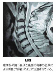 頚椎症　MRI